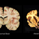 On the left, an image of a normal brain. On the right, an image of a brain with CTE.